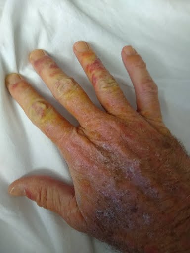 Hand skin messed up during IV antibiotics